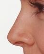 Beautiful-Noseکرم کوچک کننده بینی