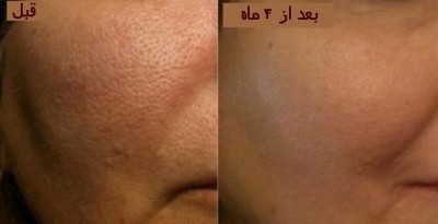 حل مشکل منافذ باز پوست با روشی غیر تهاجمی در کلینیک تخصصی پوست