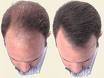 قطعی ترین درمان ریزش مو با زاندروکس