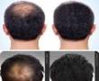 رشد طبیعی مو و درمان ریزش مو