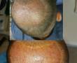 کاشت موی طبیعی و قابل رشد بدون جراحی