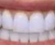 سفید کننده دندان قوی