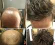 پرپشت کردن موی سر بدون عمل جراحی