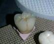 دندانسازی (فیکس)