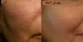 حل مشکل منافذ باز پوست با روشی غیر تهاجمی در کلینیک تخصصی پوست