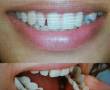دندانسازی(متحرک،ثابت)