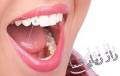نگین دندان اصلی