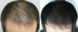 درمان ریزش مو،prpموی سر02126215363