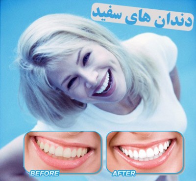 دستگاه سفید کننده دندان