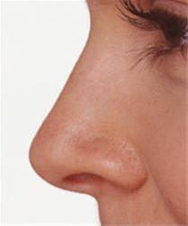 متخصص جراحی بینی و صورت ، رینوپلاستی