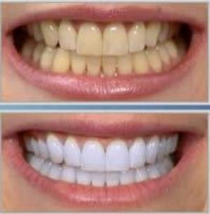 لاک سفید کننده دندان محصول امریکا