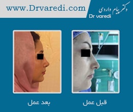 بهترین جراح زیبایی بینی استخوانی دکتر پیام واردی در تهران