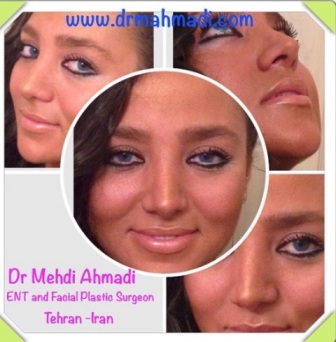بهترین جراح  بینی dr mehdi ahmadi
