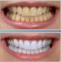 ژل سفید کننده و لایه بردار دندان