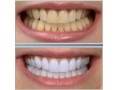 دیگر نگران دندانهای زرد خود نباشید-پک سفید کننده ی دندان