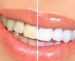سفید کردن دندان(بلیچینگ)