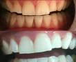 بلیچینگ سفید کردن دندانها